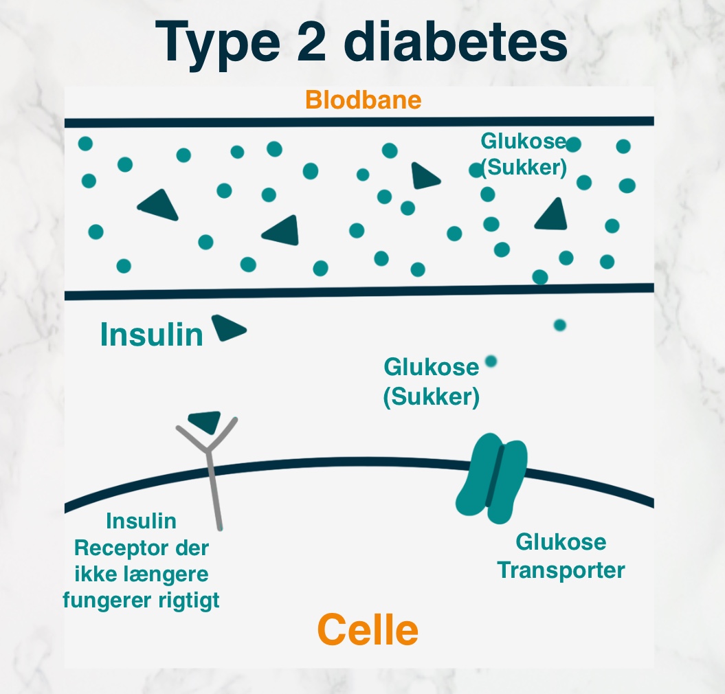Illustration af en person med type 2-diabetes.